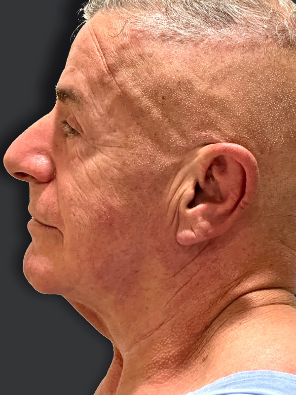 facelift-antes