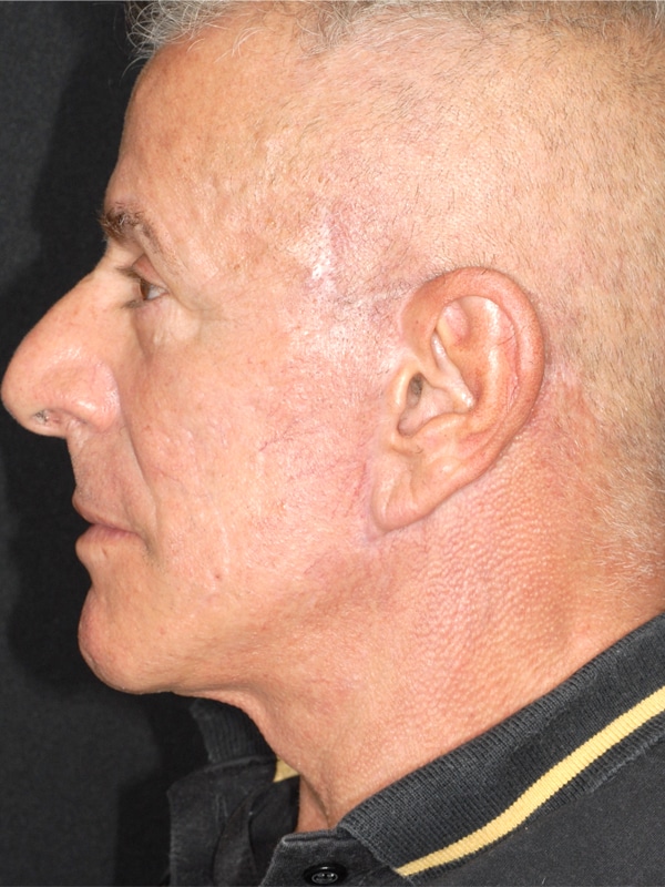 facelift-depois