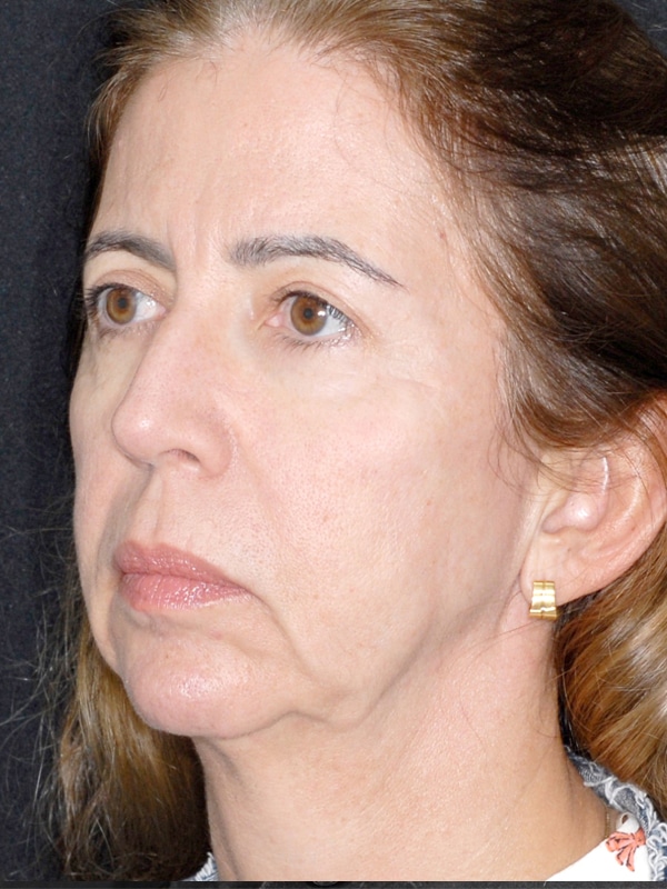facelift2-antes