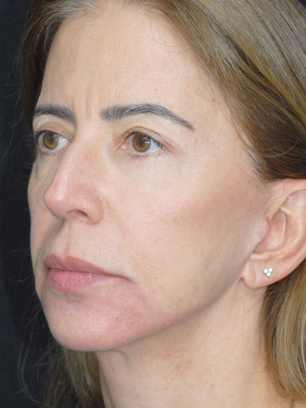 facelift2-depois