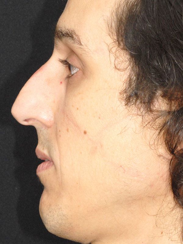 rinoplastia1b-antes rinoplastia1b-antes