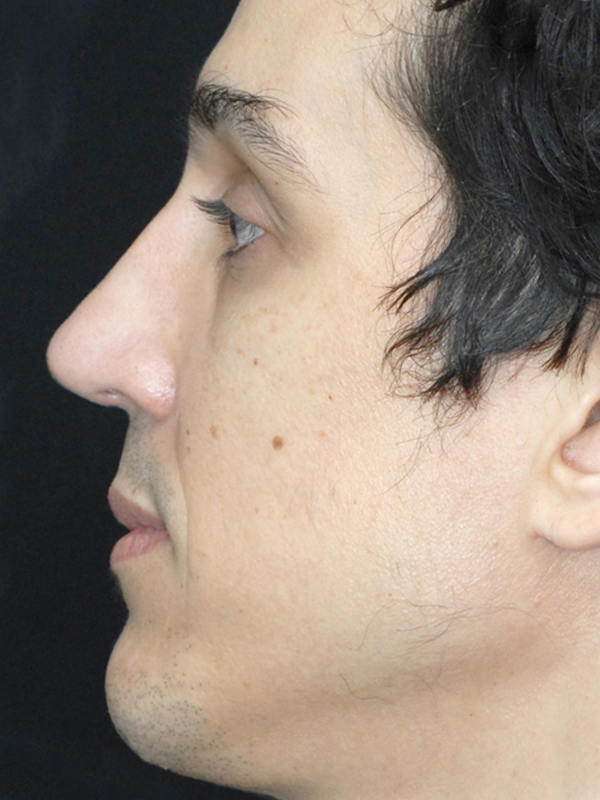 rinoplastia1b-depois